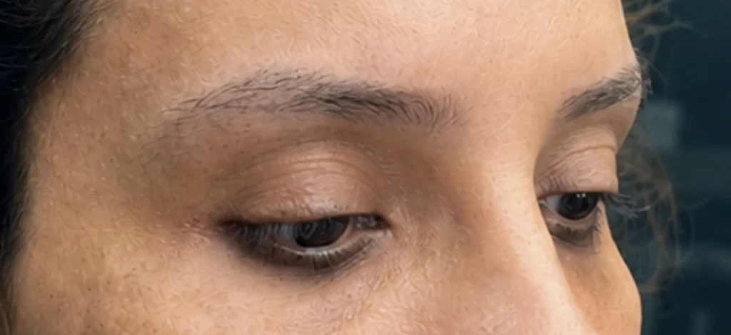 عکس قبل از کاشت ابرو در کلینیک دکتر صالح