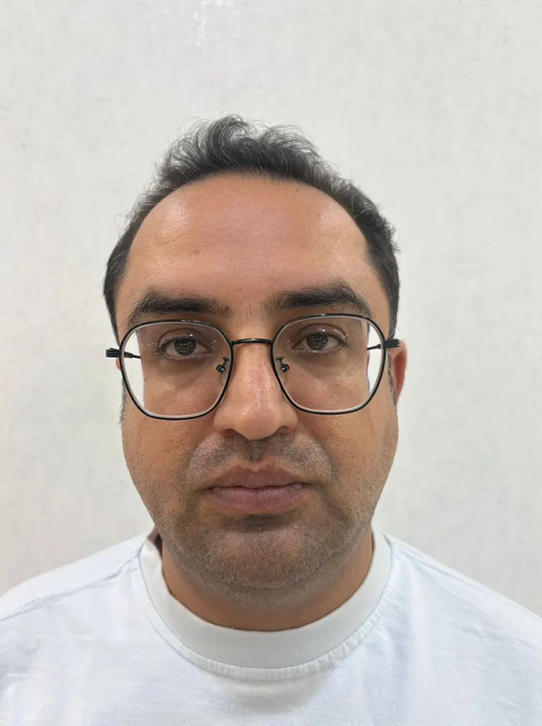 تصویر قبل از مرکز تخصصی کاشت مو در شیراز (تراکم حداکثری و خط رشد طبیعی)
