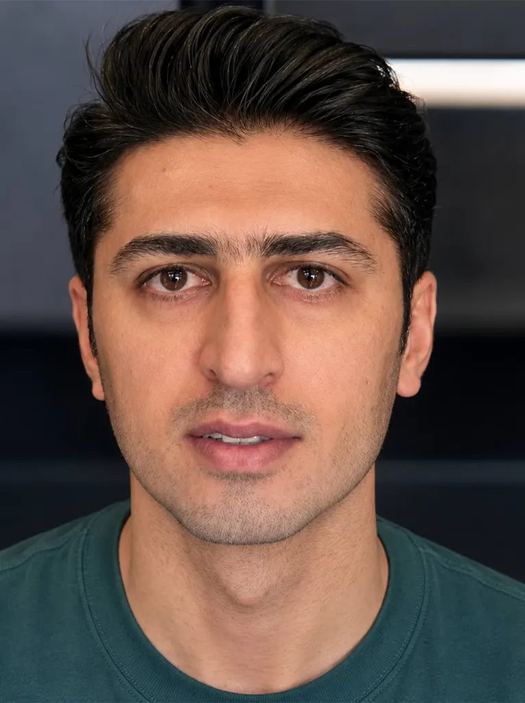 تصویر بعد از کلینیک تخصصی بلفاروپلاستی در شیراز