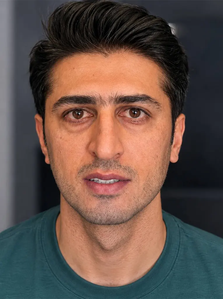 تصویر قبل از کلینیک تخصصی بلفاروپلاستی در شیراز