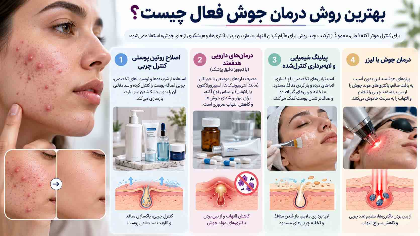 بهترین روش های درمان جوش فعال چیست؟ هرانچه که برای درمان جوش در شیراز باید بخوانید